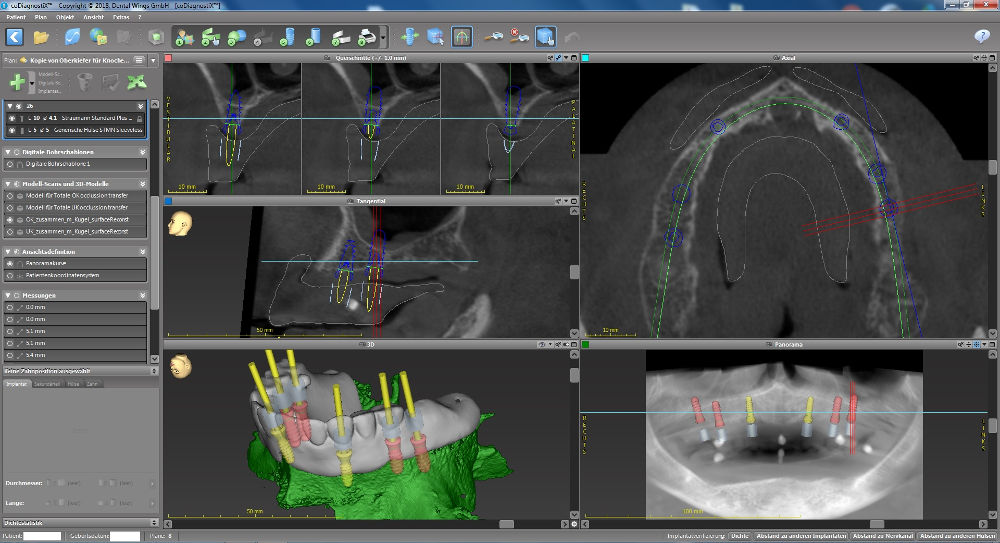 coDiagnostiX: geplante Implantate im Oberkiefer mit eingeblendeter Prothese