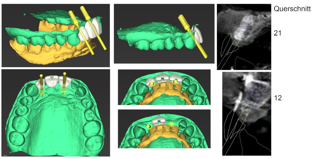 Planungsdokument Oberkiefer: 3D-Ansichten mit Implantatachsen und Querschnitte