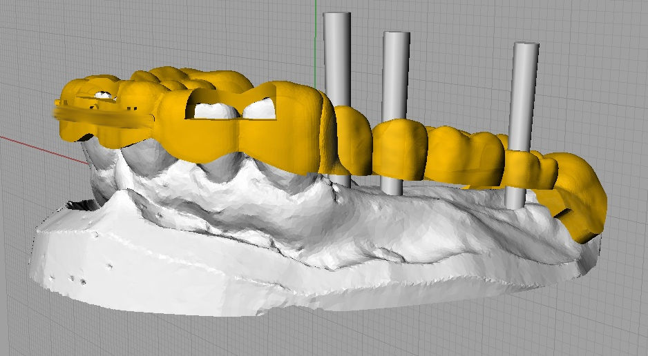 Schablone in der CAD-Software, im Implantatbereich hohlgelegt, mit drei Achsen